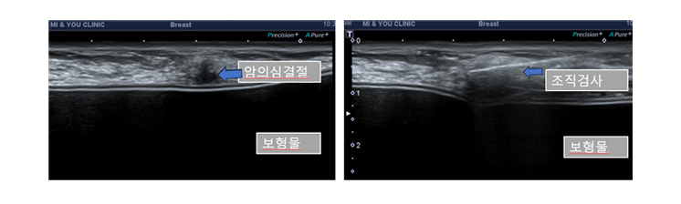 유방보형물 검사